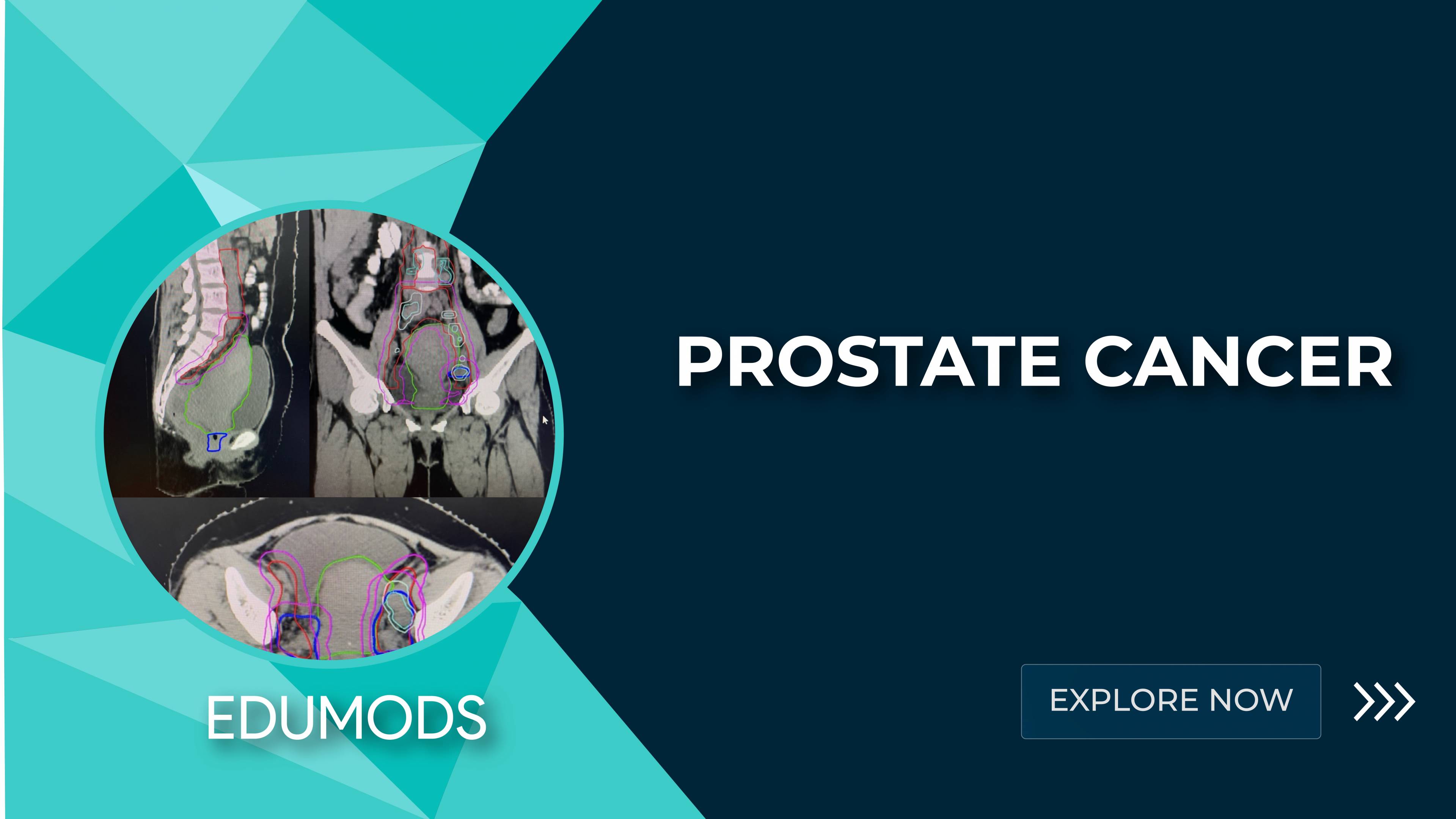 edumods_prostatecancer.jpg