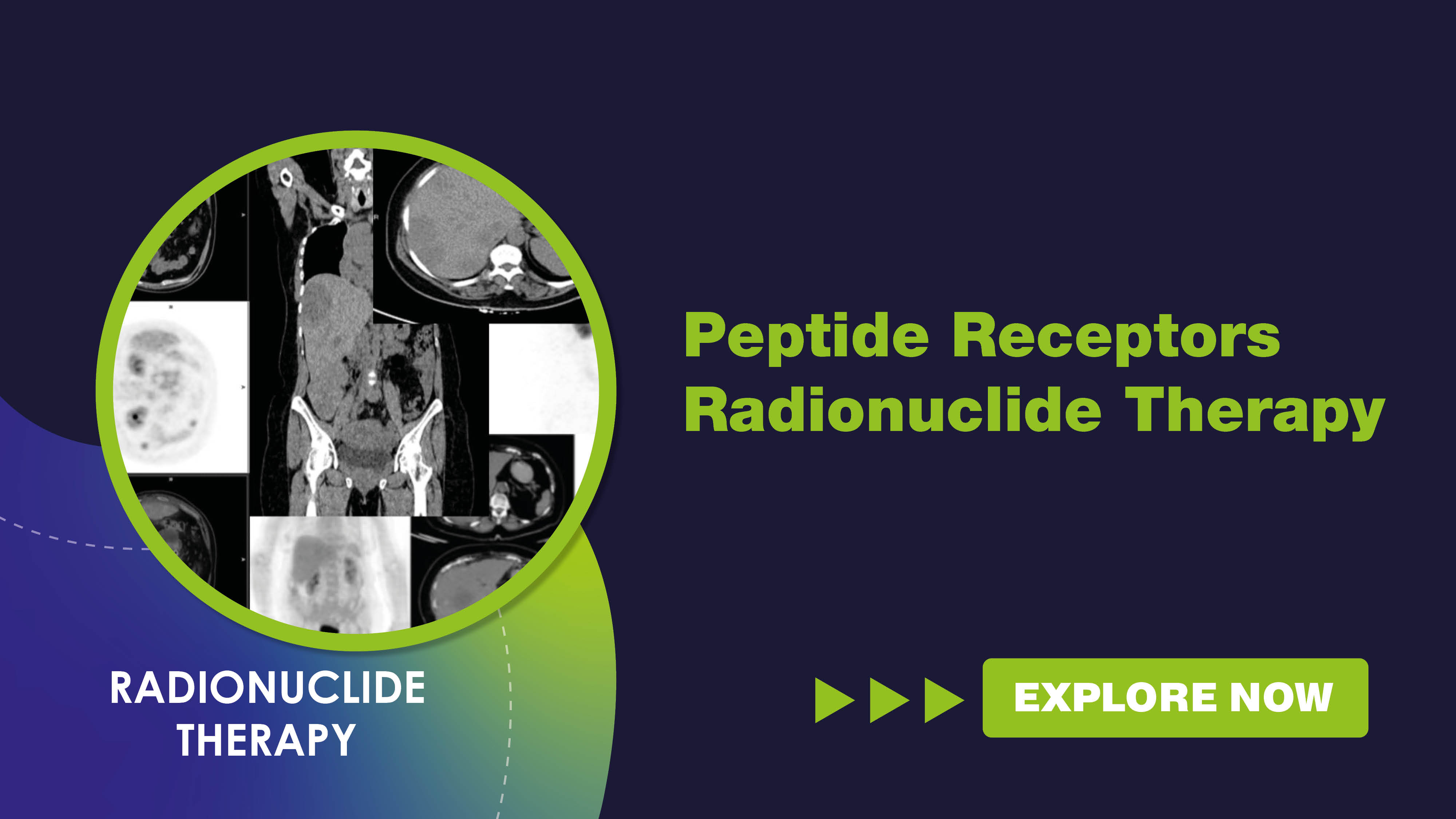 peptidereceptorsradionuclidetherapy.jpg