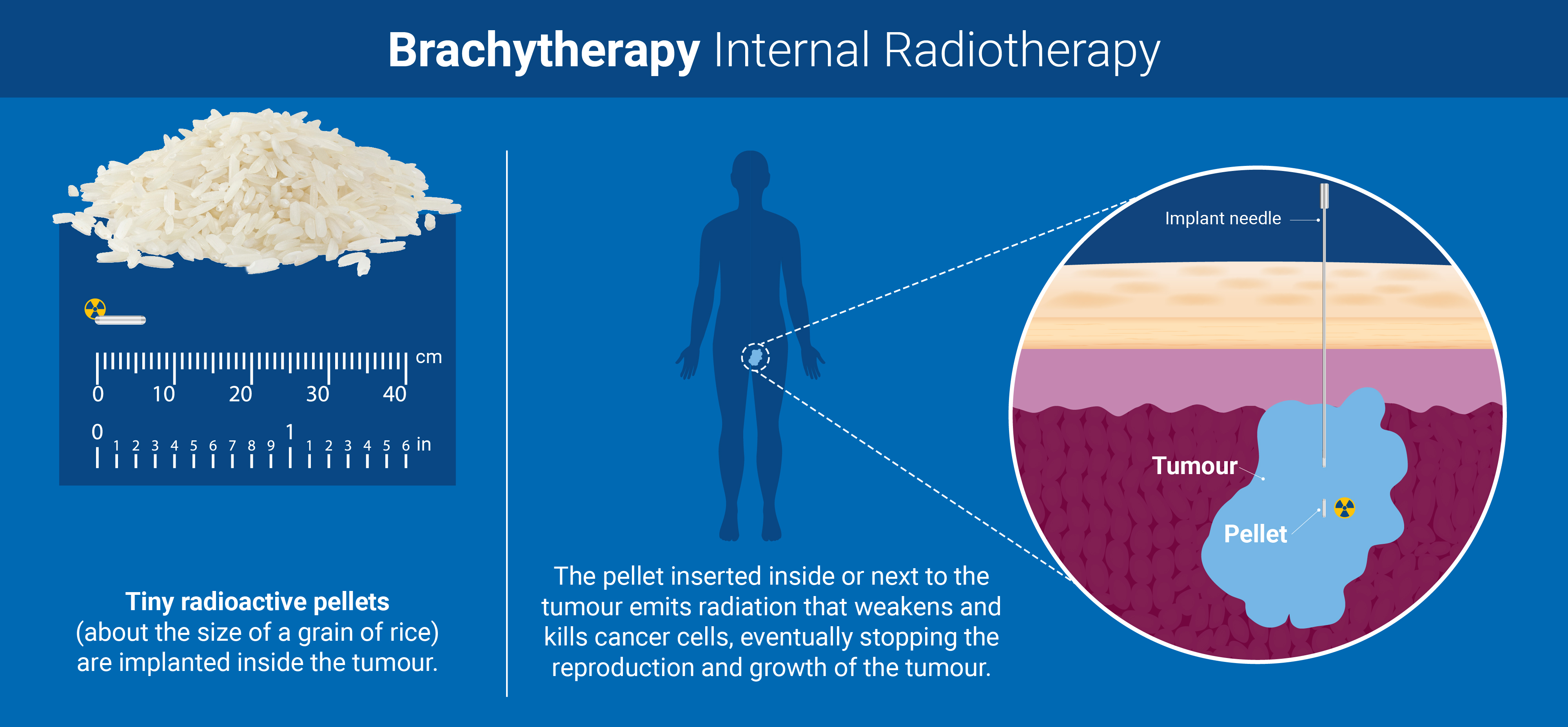 radiotherapy_v3_brachytherapy.jpg