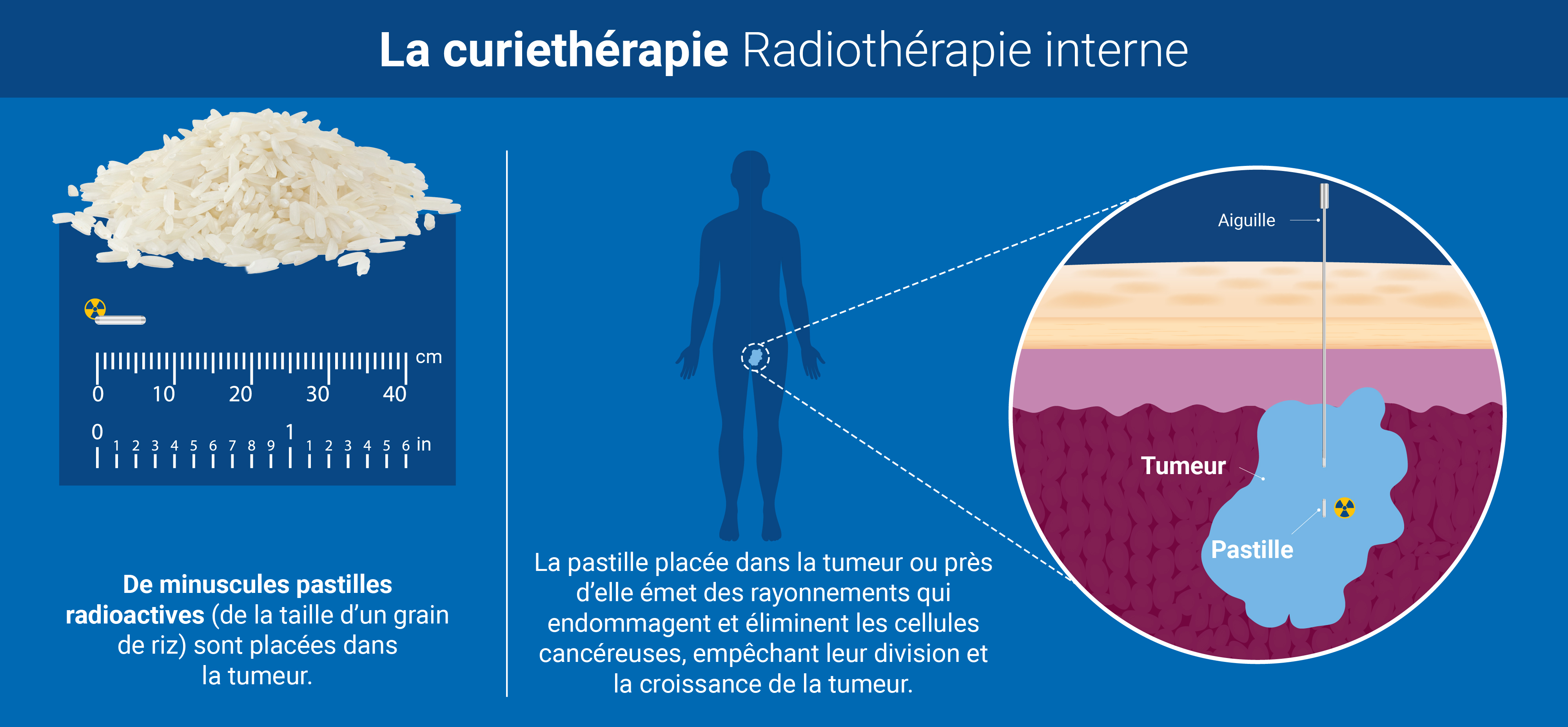 radiotherapy_v3_fr_brachytherapy.jpg