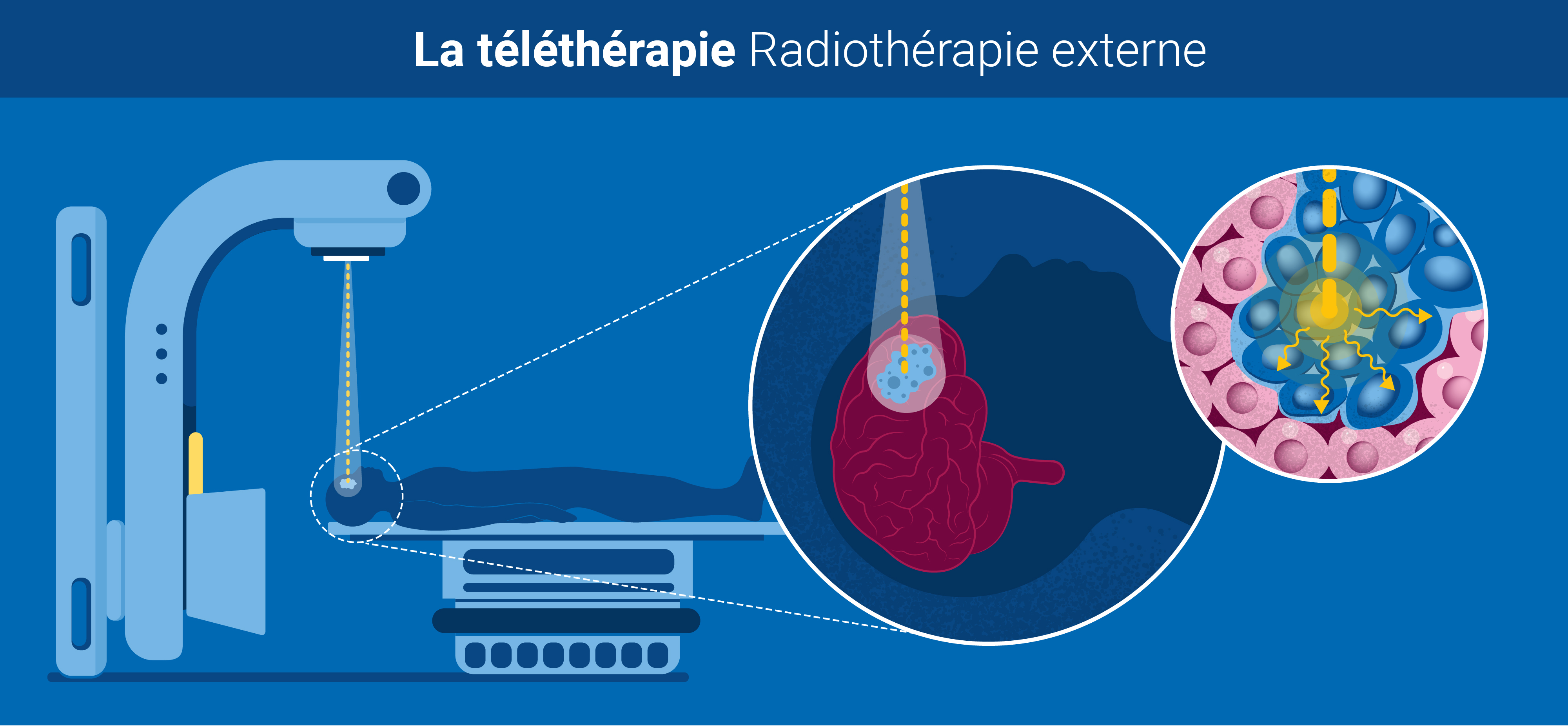 radiotherapy_v3_fr_teletherapy.jpg