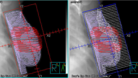 Transitioning from 2-D Radiation Therapy to 3-D Conformal Radiation Therapy and Intensity Modulated Radiation Therapy: Presentation Slides
