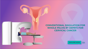 Conventional Simulation for Whole Pelvis RT (WPRT) For Cervical Cancer
